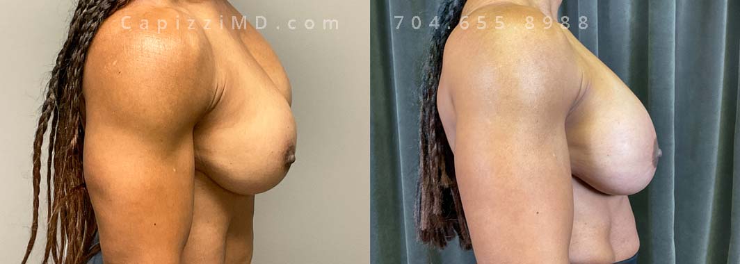 This patient was experiencing tightening in the left breast which ended up being an intracapsular rupture of her Mentor Smooth MP 500cc silicone implant. She wanted a larger look with volume in the upper pole. She received an implant exchange and mini breast lift with Sientra Smooth Round HP 620cc implants.