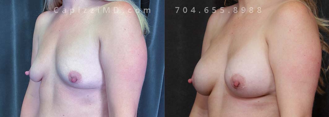 This patient wanted to add subtle volume and resize/reposition her areolas. A breast augmentation with Sientra Smooth Round HP 280cc implants and a mini lift helped her achieve her goals.