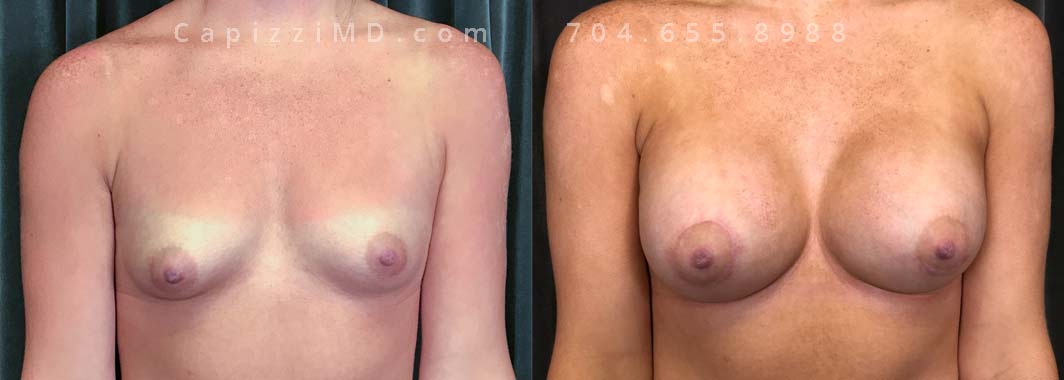 Seeking to fix asymmetry and gain volume, this patient opted for a breast augmentation with mini lift. Sientra Smooth Round HP 330cc implants achieved the fullness, and a mini lift recentered her nipples, achieving a harmonious balance.