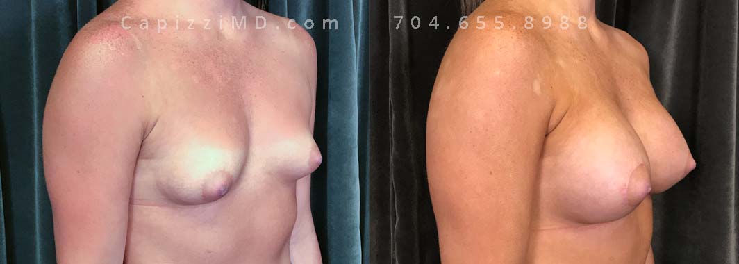 Seeking to fix asymmetry and gain volume, this patient opted for a breast augmentation with mini lift. Sientra Smooth Round HP 330cc implants achieved the fullness, and a mini lift recentered her nipples, achieving a harmonious balance.