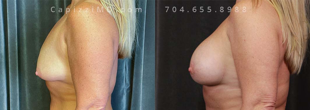 This patient was dreaming of better breast volume and perkier nipples. A breast augmentation with Sientra Smooth Round HP 385cc implants and Benelli lift helped her achieve her goals of beautiful, natural breasts!