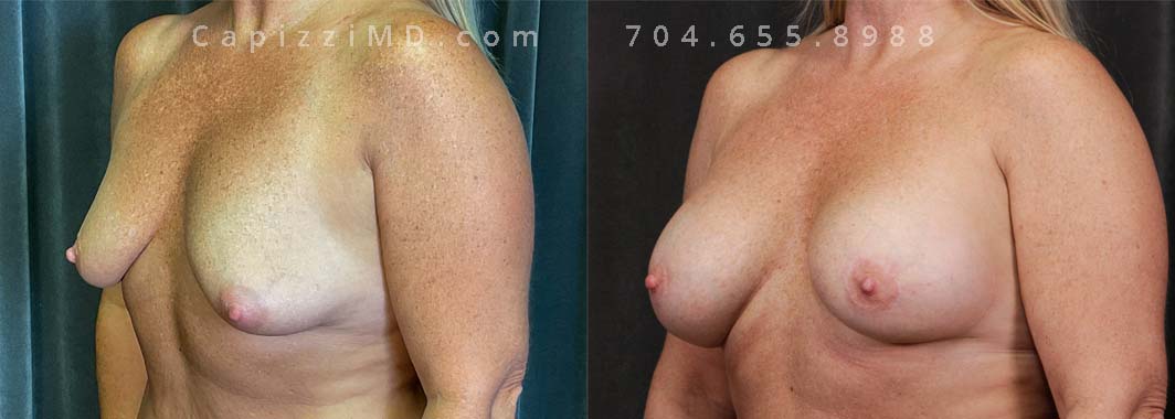 This patient was dreaming of better breast volume and perkier nipples. A breast augmentation with Sientra Smooth Round HP 385cc implants and Benelli lift helped her achieve her goals of beautiful, natural breasts!
