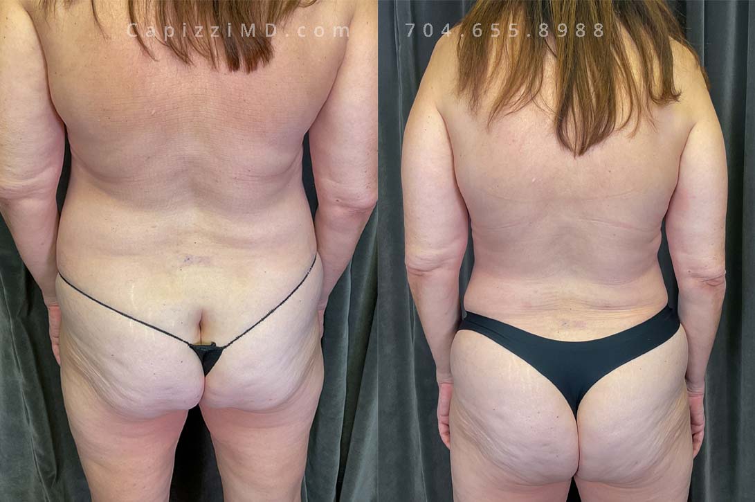 A modified lift restored youthful lift to her breasts, while a tummy tuck meticulously redefined her abdominal contours, fulfilling this woman's desire for a pre-baby physique.