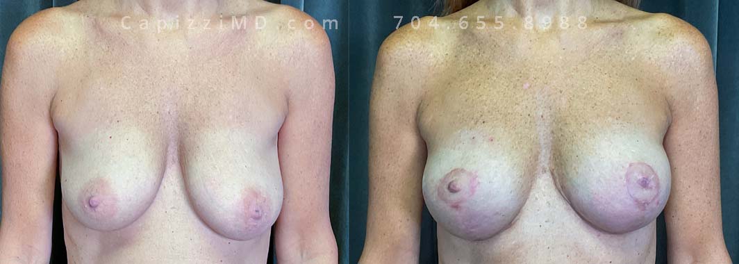 Opting to preserve her natural volume whilst restoring nipple positioning, this young patient underwent a modified lift to effectively counteract ptosis. An inverted nipple repair was also completed to address her concerns.