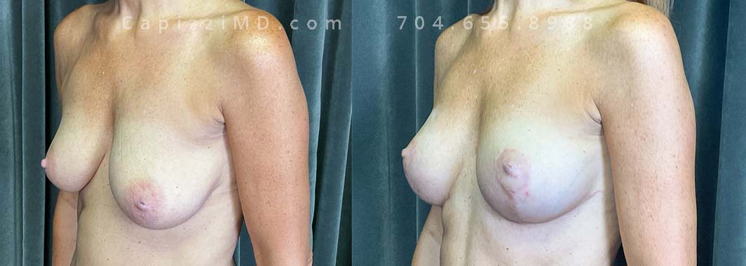 Opting to preserve her natural volume whilst restoring nipple positioning, this young patient underwent a modified lift to effectively counteract ptosis. An inverted nipple repair was also completed to address her concerns.