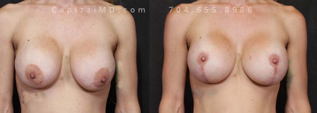 This patient opted for a lift revision and implant exchange to give her a look that better aligned with her lifestyle.