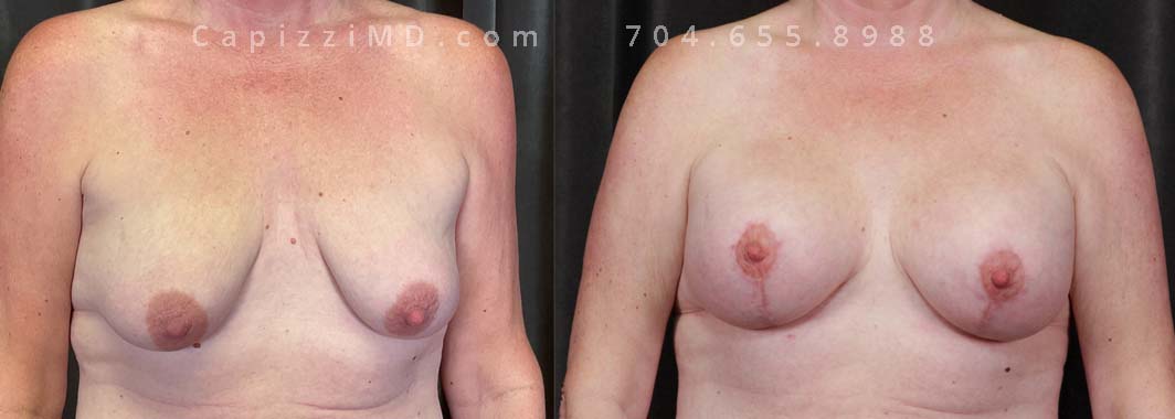 Seeking to augment breast volume and optimize nipple positioning, this patient underwent a modified lift with augmentation. This procedure effectively addressed ptosis and resulted in a desired increase in cup size.