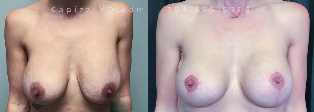 This patient had implants placed over 20 years ago and was seeking a change to something smaller. An implant exchange gave her the perfect size while repositioning her nipples perfectly.