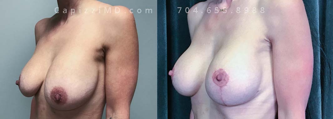 This patient had implants placed over 20 years ago and was seeking a change to something smaller. An implant exchange gave her the perfect size while repositioning her nipples perfectly.