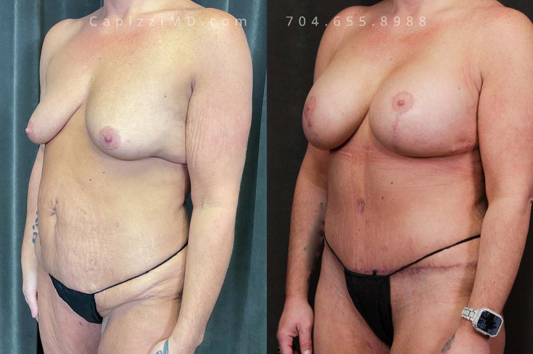 Yearning for the confidence of her pre-baby shape, this woman achieved it through a combined approach. A modified breast lift with augmentation added volume and lift, while a tummy tuck and liposuction sculpted her abdomen, defining her waist and hips.