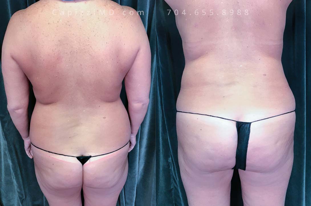 This patient desired better upper pole volume and lift. A modified lift with exchange from shaped to round implants gave her the look she was dreaming of.
