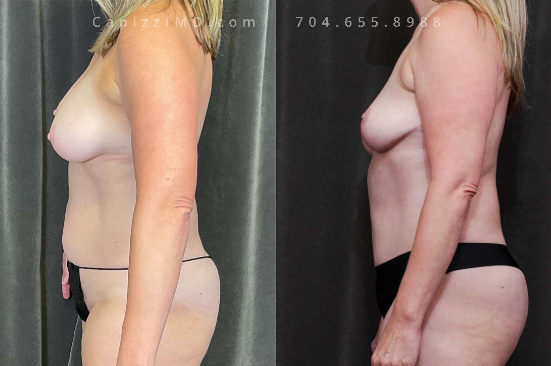 After children, this patient was most interested in re-aligning and resetting her physique. A modified lift helped to correct the sagging skin in her breasts while a tummy tuck and liposuction gave her the tummy she had always dreamed of!