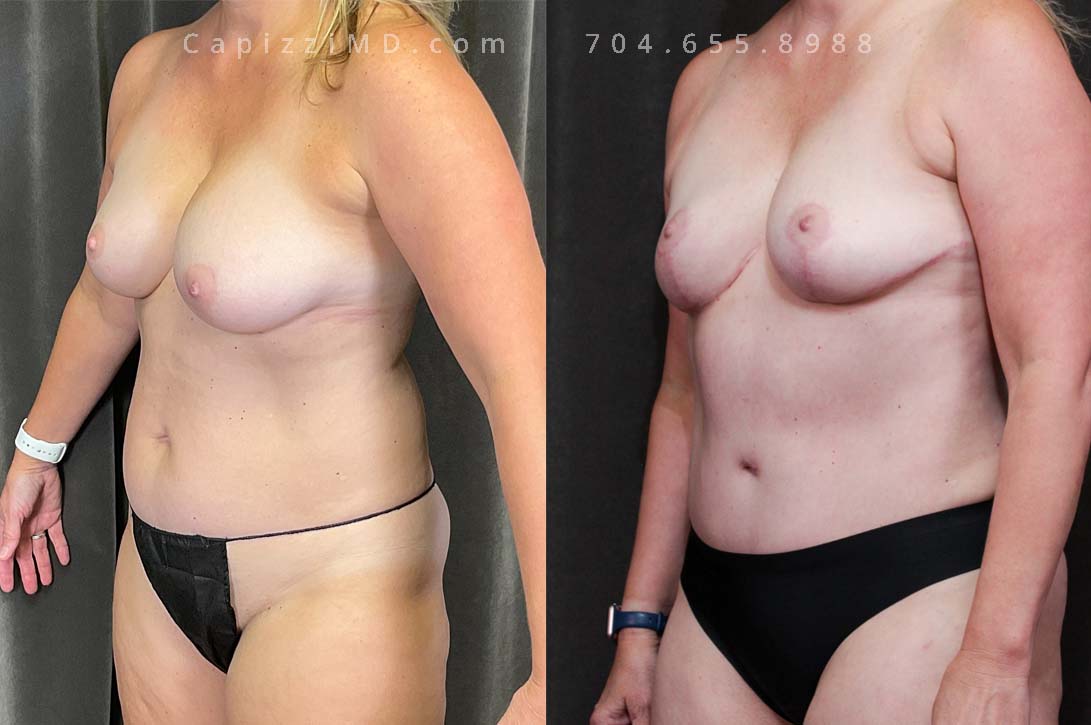 After children, this patient was most interested in re-aligning and resetting her physique. A modified lift helped to correct the sagging skin in her breasts while a tummy tuck and liposuction gave her the tummy she had always dreamed of!