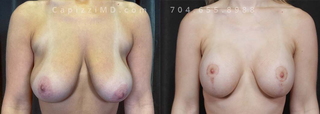 This young patient wanted to enhance her breast volume while re-aligning her nipples. A modified lift with breast augmentation helped to correct her ptosis (dropping) and give her an additional cup size.