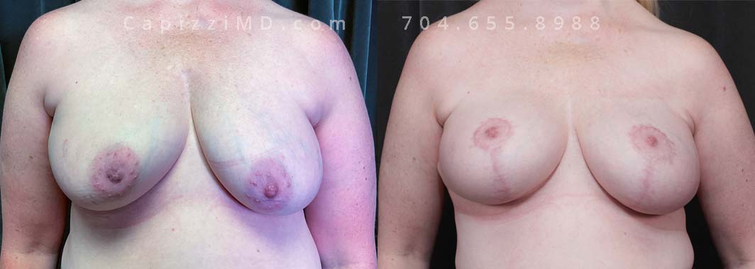 A breast augmentation with modified lift (R) and full lift (L) combined with liposuction was the treatment plan to enhance breast volume while also addressing asymmetry.