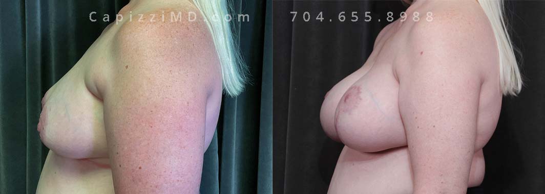 A breast augmentation with modified lift (R) and full lift (L) combined with liposuction was the treatment plan to enhance breast volume while also addressing asymmetry.