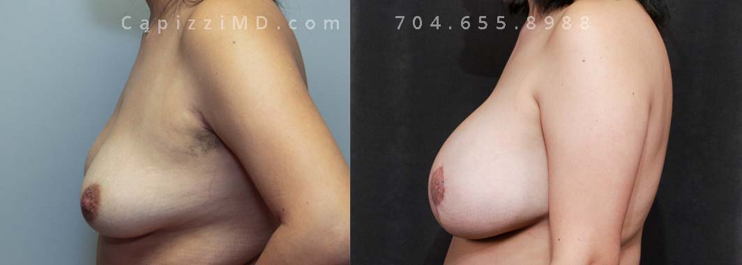 This patient wanted bigger breasts. Due to the integrity of her tissue, an internal bra was added to assist in supporting the implants long-term. Liposuction to the bra roll helped create a beautiful contour.