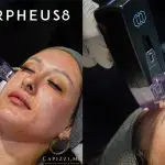 Is Radiofrequency RF Microneedling the Secret to Tighter-Skin?