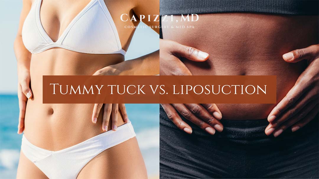 Tummy Tuck vs. Liposuction What's the Difference? Comparison image between both procedures.