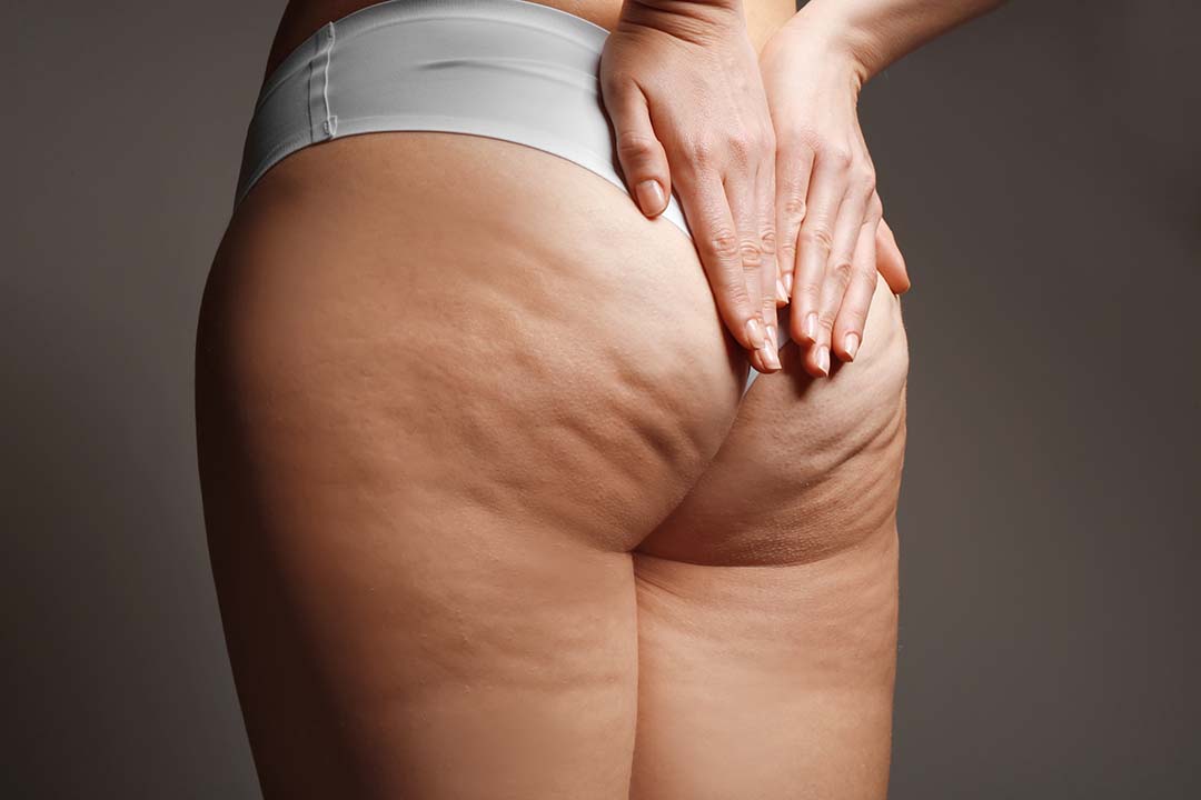 Aveli A Permanent Cellulite Treatment