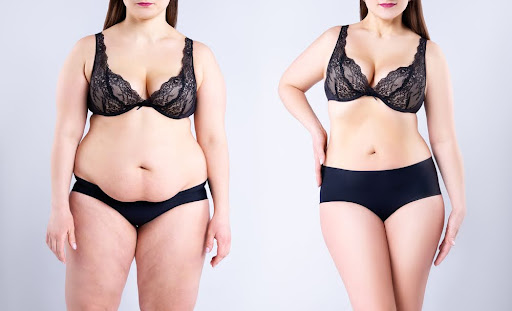 A woman’s before and after showcasing why a tummy tuck is good for post-pregnancy.