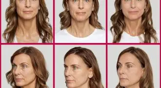 Sculptra