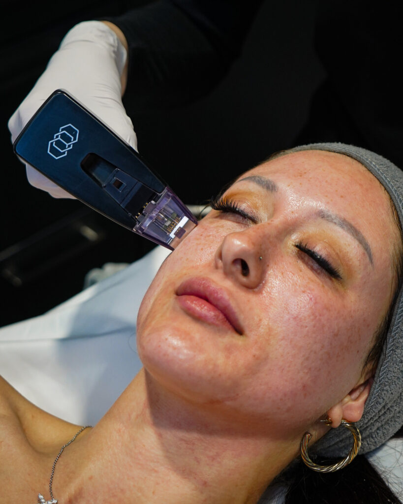 Morpheus8 treatment of the face at Capizzi MD in Charlotte, North Carolina