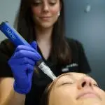 Microneedling Treatment