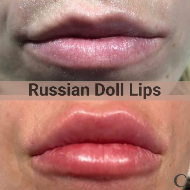 Russian Doll Lip Filler before and after pictures.